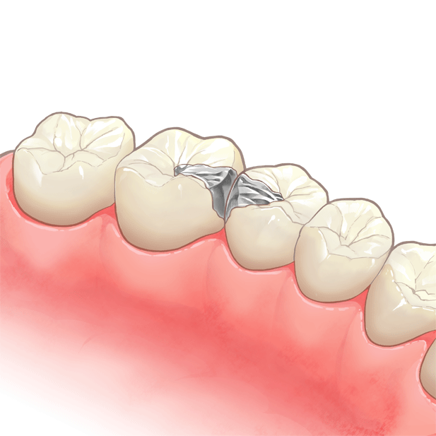 セラミック インレー