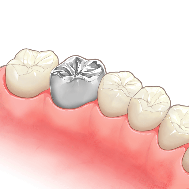 セラミック クラウン